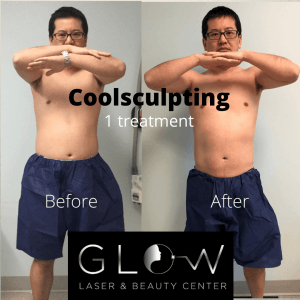 CoolSculpting Treatment 1 - Before And After 