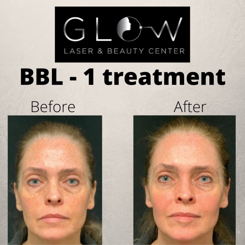 Forever Young BBL Treatment in Erie, PA - Glow Laser and Beauty Center