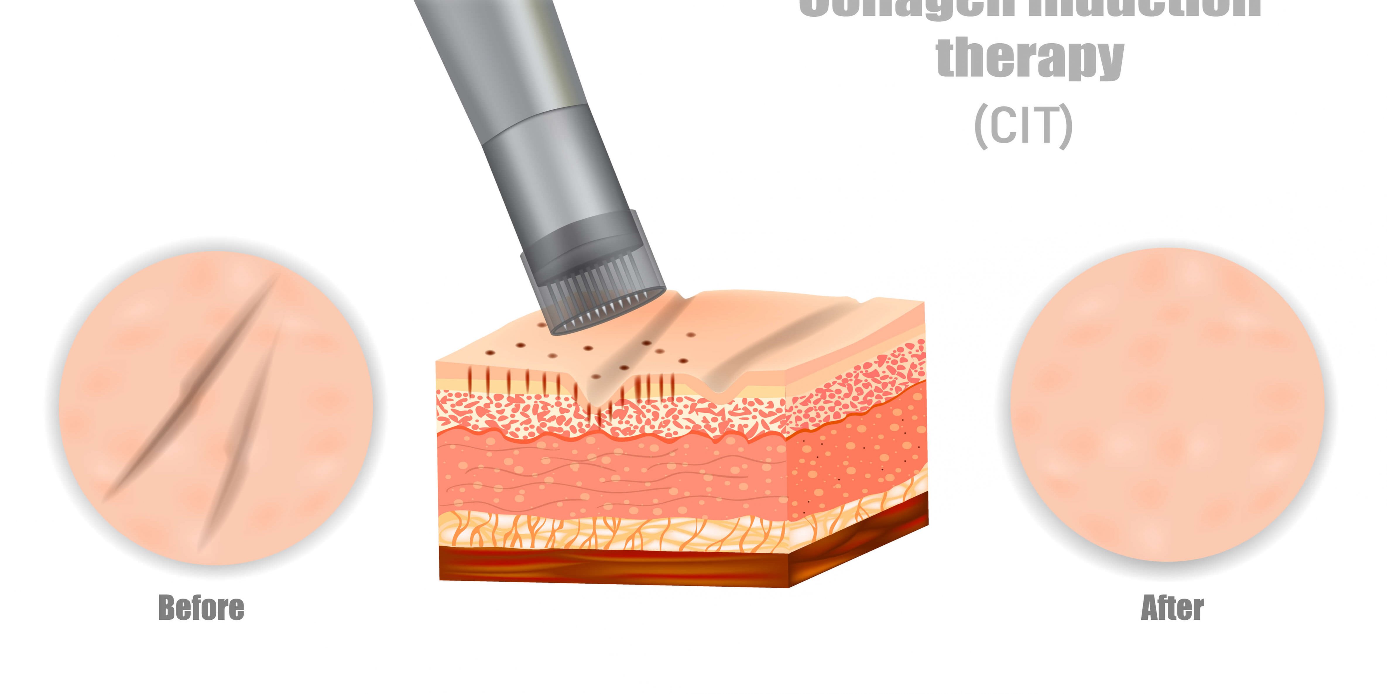Collagen Induction Therapy? - Glow Laser And Beauty Center