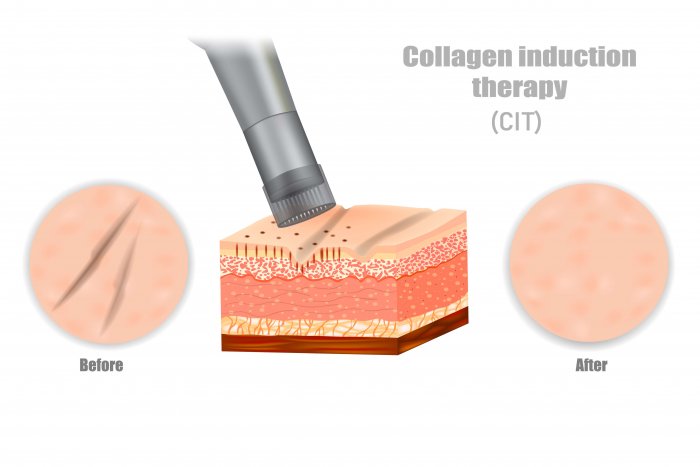 Collagen Induction Therapy in Erie, PA | Glow Laser and Beauty Center