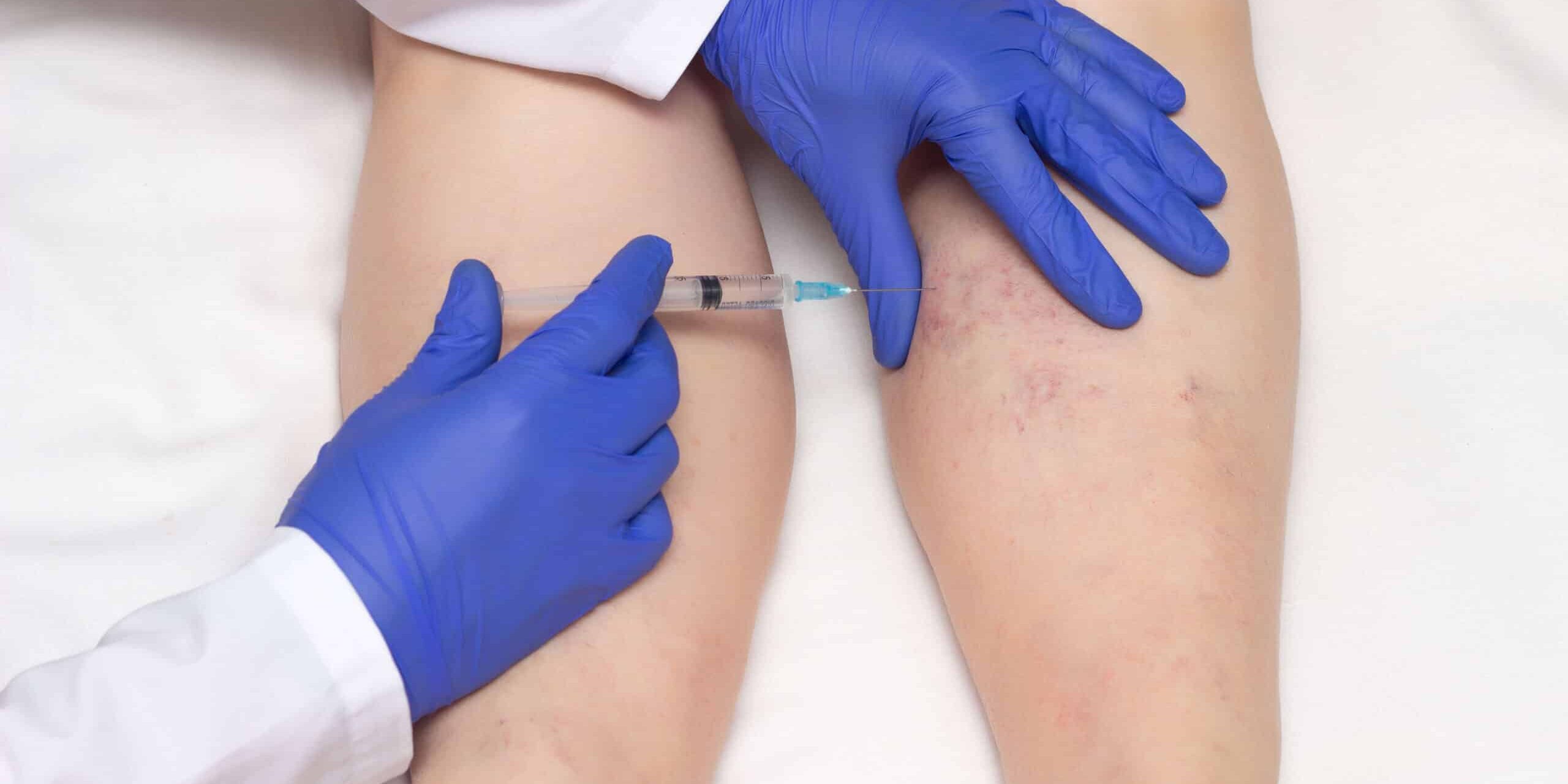 Sclerotherapy in Erie, PA | Glow Laser and Beauty Center