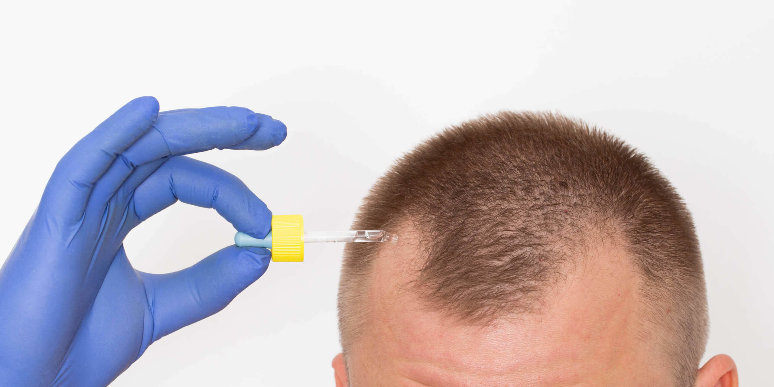 Hair loss  Symptoms and causes  Mayo Clinic