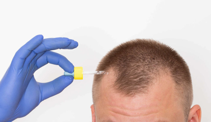 Thinning Hair: Causes and Treatment by Vampire Hair Restoration