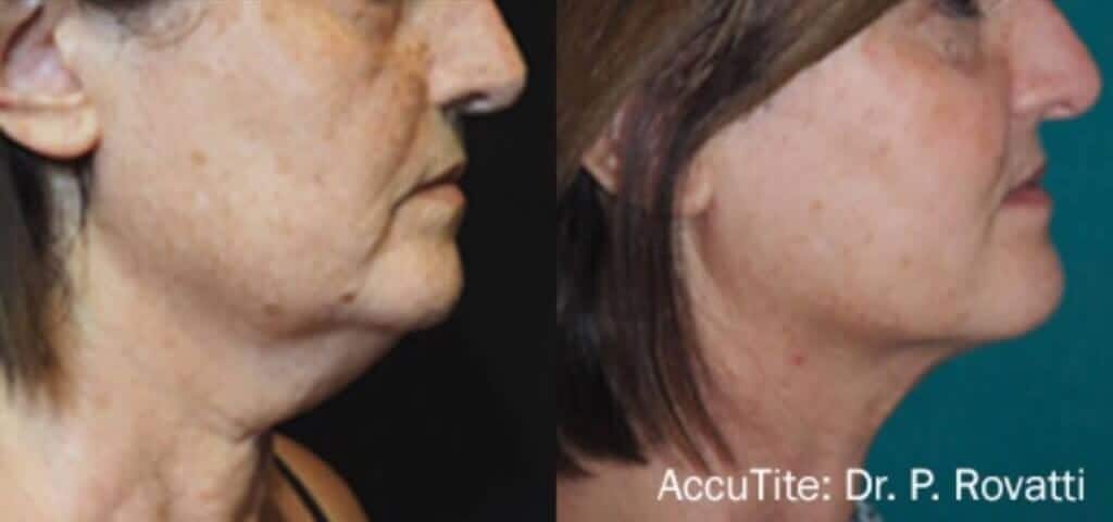 AccuTite St. Suite 3100 Erie PA 16509 glowlaserbeauty