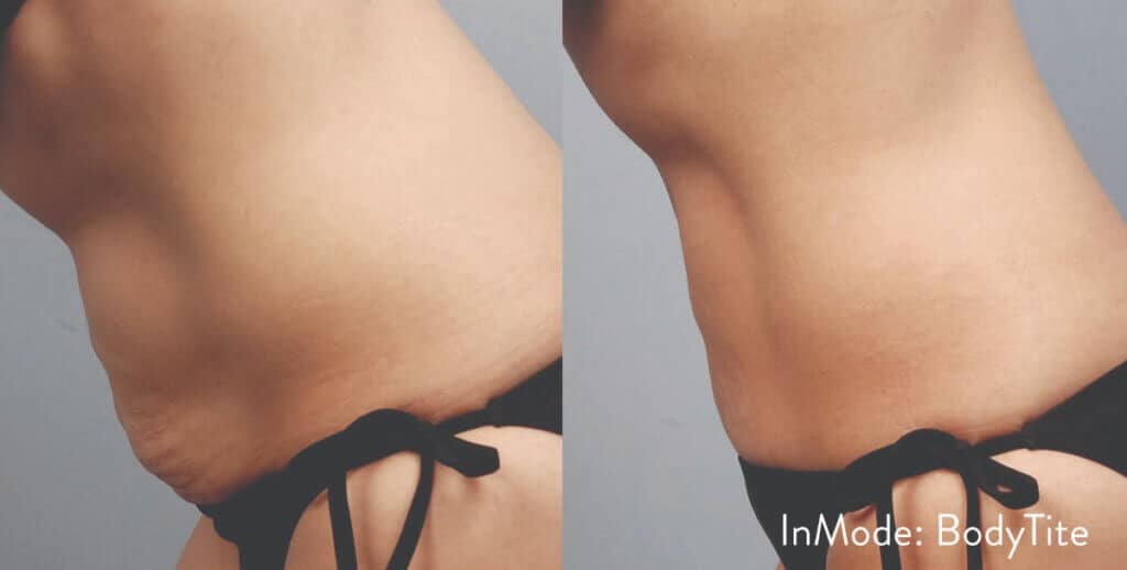 BodyTite St. Suite 3100 Erie PA 16509 glowlaserbeauty