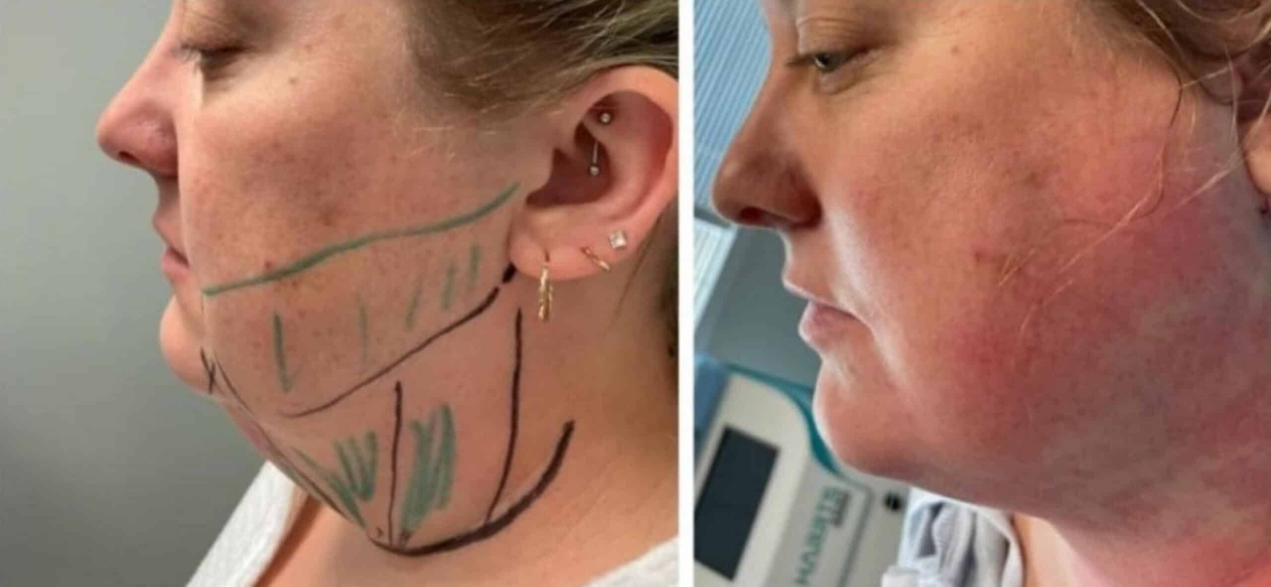 FaceTite St. Suite 3100 Erie PA 16509 glowlaserbeauty