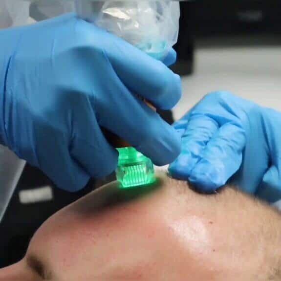 RadioFrequency Treatments St. Suite 3100 Erie PA 16509 glowlaserbeauty