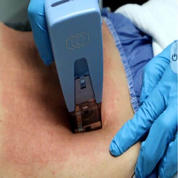 SkinTyte Treatment St. Suite 3100 Erie PA 16509 glowlaserbeauty