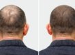 Understanding Your Options for Hair Loss Treatments