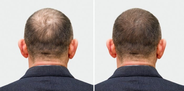 Understanding Your Options for Hair Loss Treatments