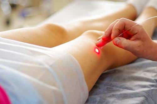 Laser Treatments for Veins