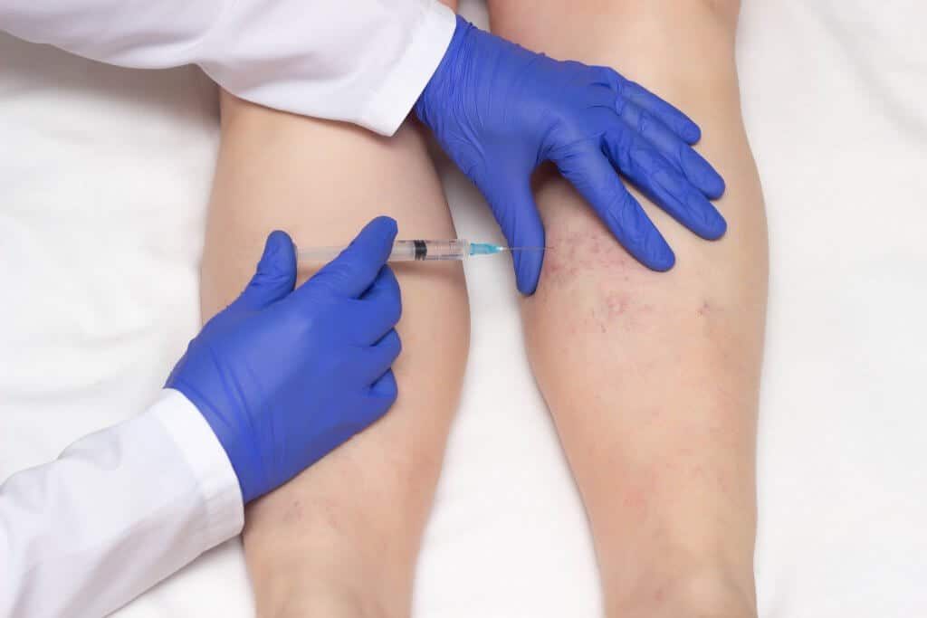 Sclerotherapy in Erie, PA | Glow Laser and Beauty Center