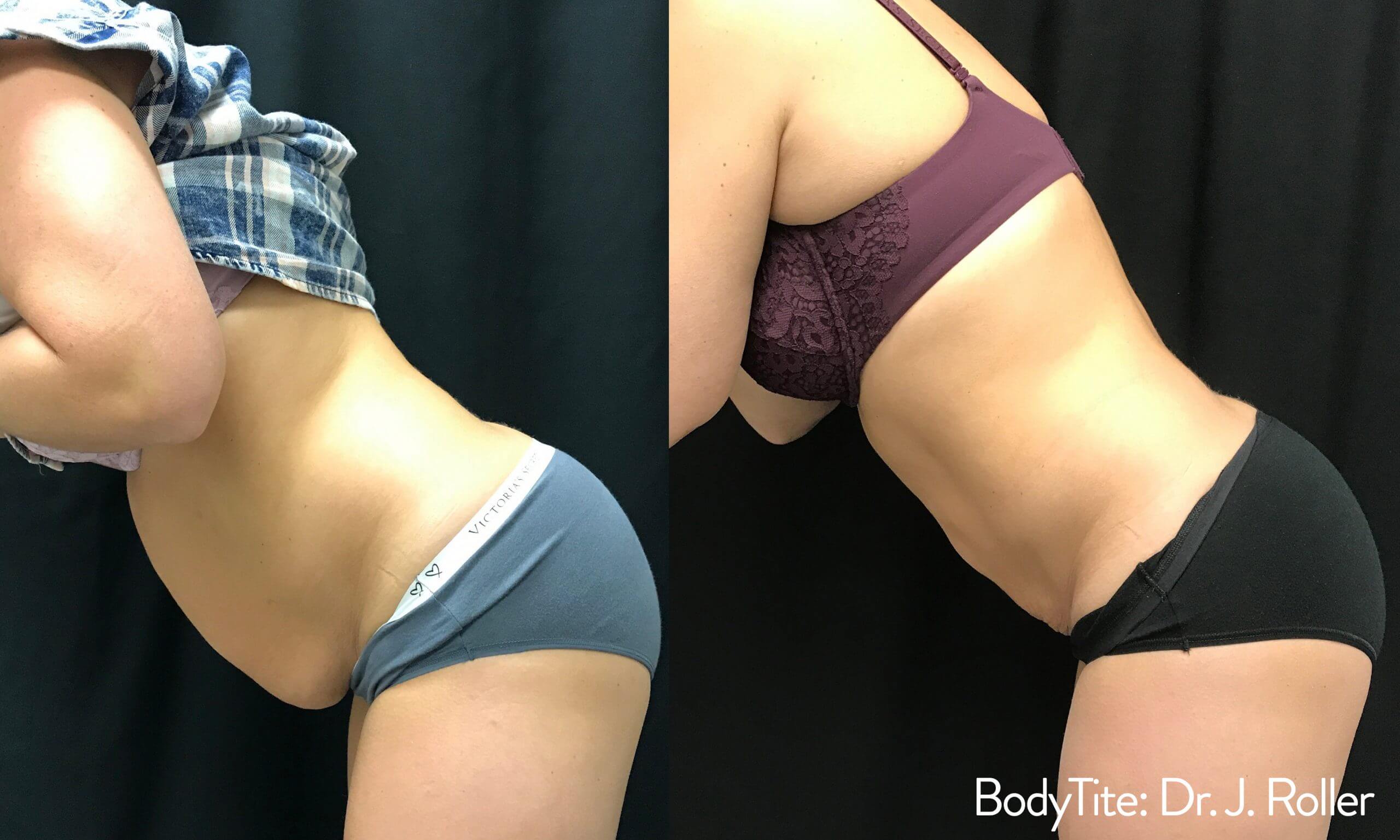 JR_4a_BodyTite-scaled JR_4a_BodyTite