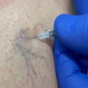Sclerotherapy St. Suite 3100 Erie PA 16509 glowlaserbeauty