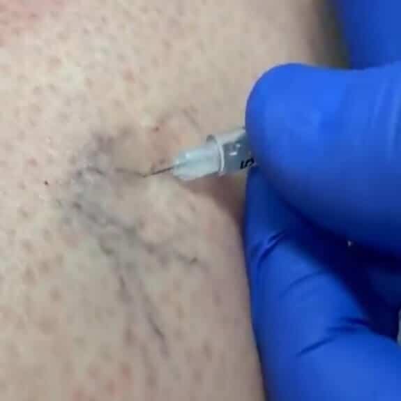 Sclerotherapy St. Suite 3100 Erie PA 16509 glowlaserbeauty