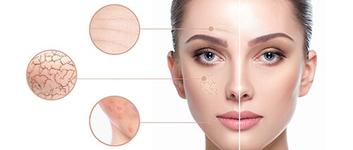 Female face close-up, showing skin problems. Dry skin, acne, wrinkles and other imperfections. Rejuvenation, hydration and skin treatment