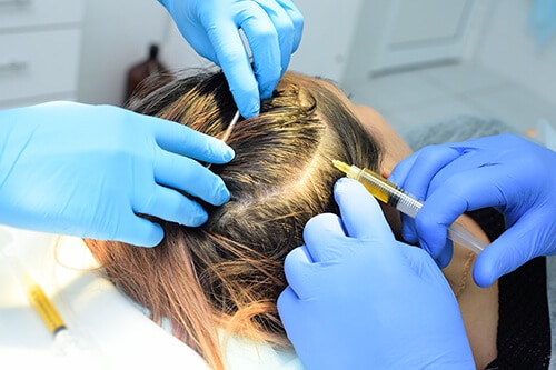 doctor cosmetologist dermatologist injects the plasma into the scalp of the patient.
