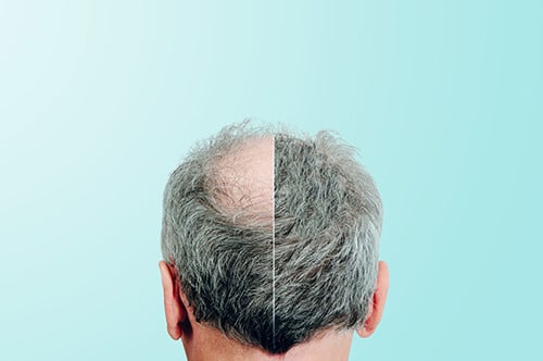 Before and after, Rear view of a male head without hair. Hair lo