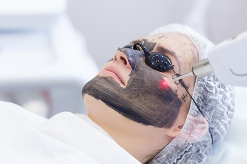 Process of photothermolysis, warming the skin, laser carbon peeling