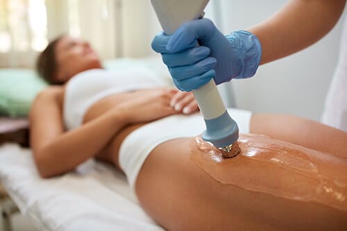 Correction cellulite figures with acoustic wave therapy in the